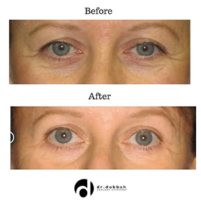 before and after eye procedure front view