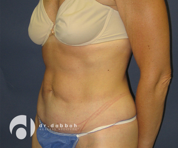 after abdominoplasty left view female patient case 2564