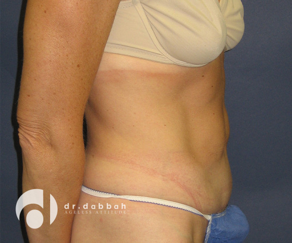 after abdominoplasty right side view female patient case 2564