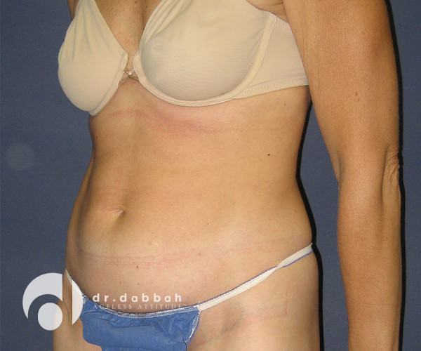 before abdominoplasty left view female patient case 2564