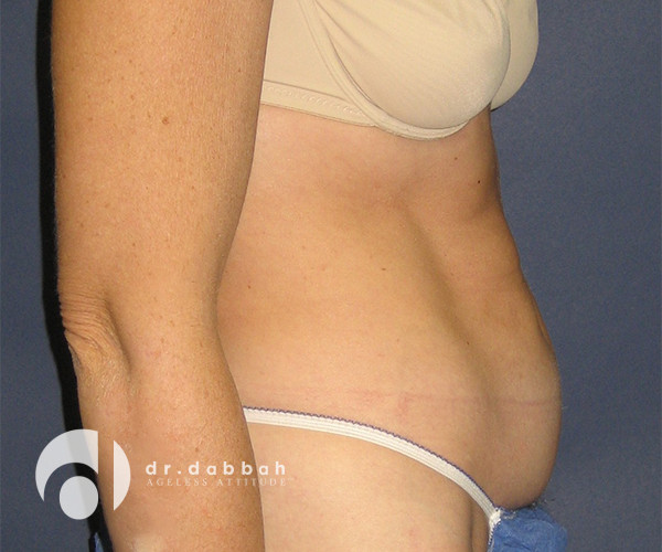 before abdominoplasty right side view female patient case 2564