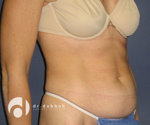 before abdominoplasty right view female patient case 2564