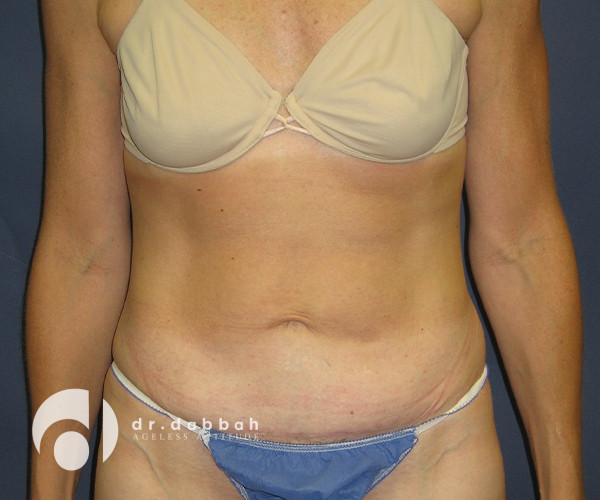 after abdominoplasty front view female patient case 2564