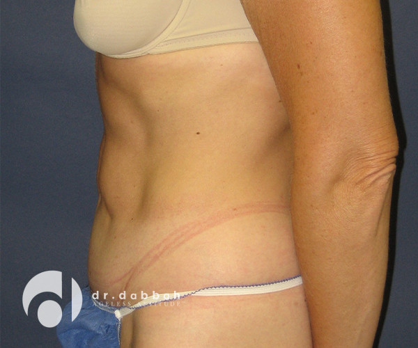 after abdominoplasty left side view female patient case 2564