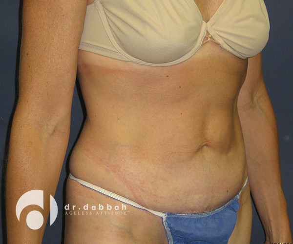 after abdominoplasty right view female patient case 2564