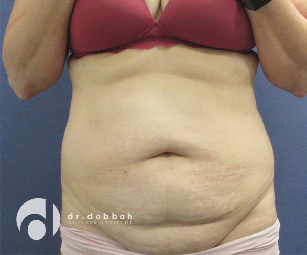 before abdominoplasty front view female patient case 2575