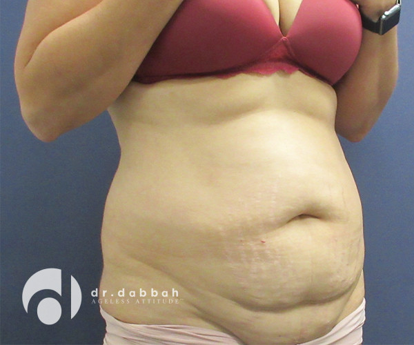 before abdominoplasty right view female patient case 2575