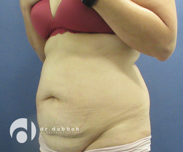 before abdominoplasty left view female patient case 2575