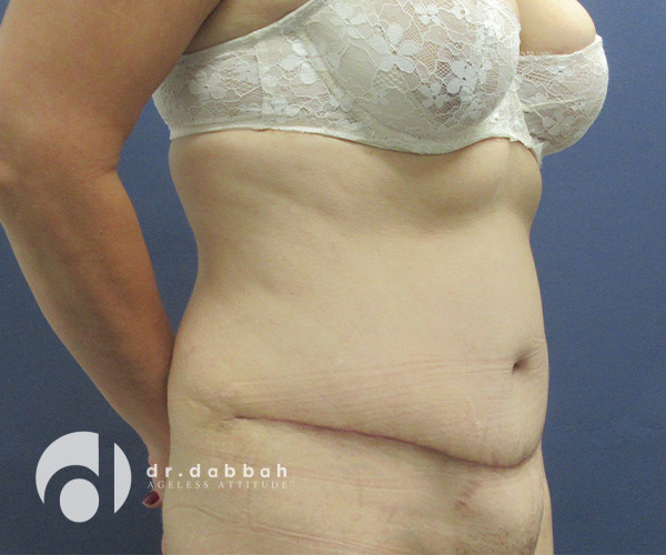 after abdominoplasty right view female patient case 2575