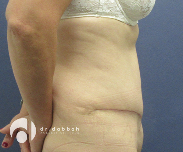 after abdominoplasty right side view female patient case 2575
