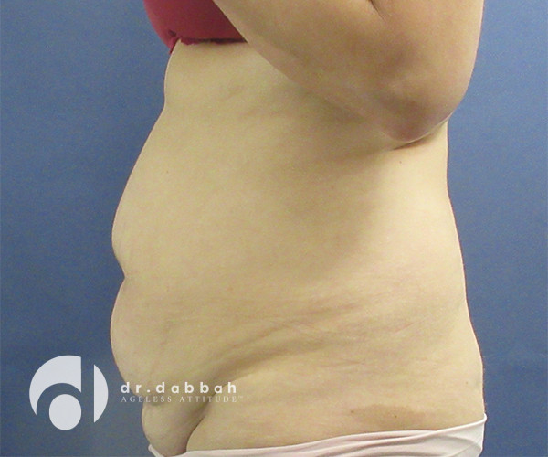 before abdominoplasty left side view female patient case 2575