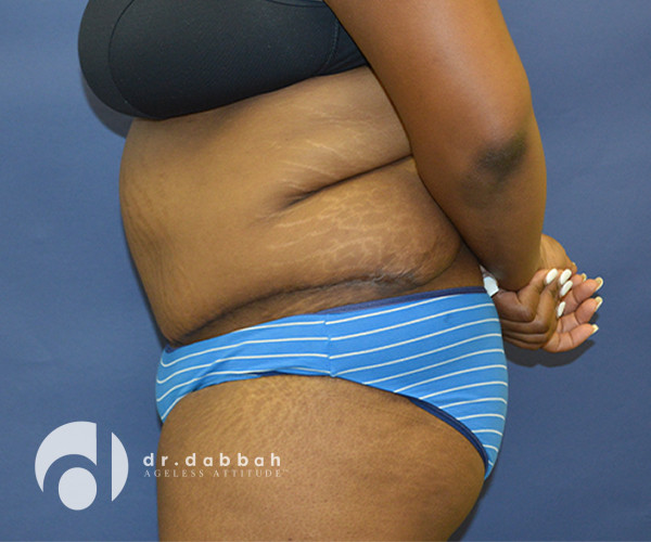after abdominoplasty left side view female patient case 2587