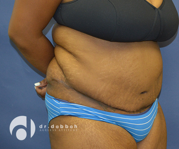after abdominoplasty front right diagonal view female patient case 2587