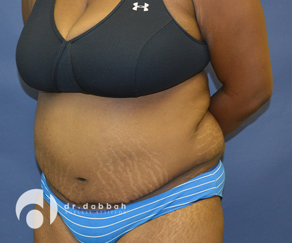 after abdominoplasty front left diagonal view female patient case 2587