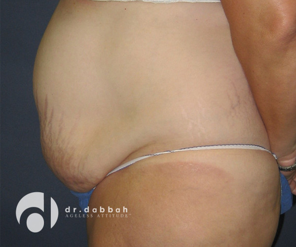 before abdominoplasty left side view female patient case 2598