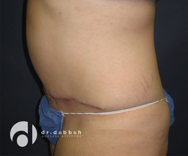 after abdominoplasty left side view female patient case 2598