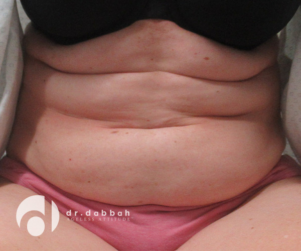 before abdominoplasty view of patient sitting down case 2612 | Dr. Albert Dabbah Boca Raton, FL