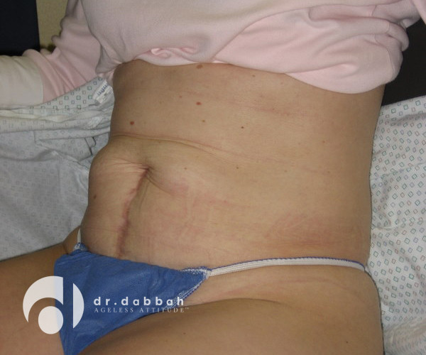 before abdominoplasty view of patient sitting down case 2615 | Dr. Albert Dabbah Boca Raton, FL