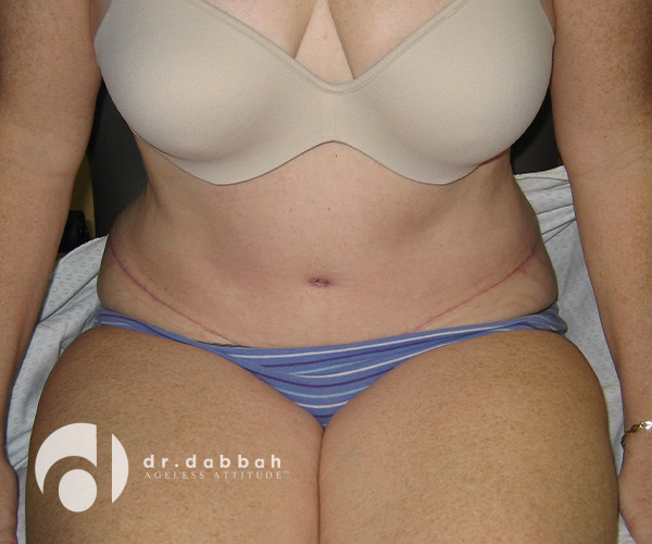after abdominoplasty front view female patient case 2618