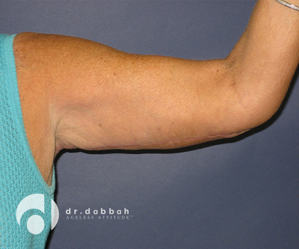 after armlift left arm front view female patient case 2548