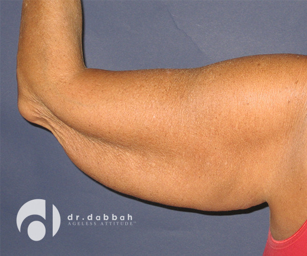 before armlift left arm back view female patient case 2548