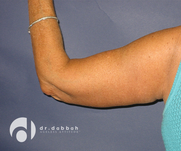 after armlift left arm back view female patient case 2548