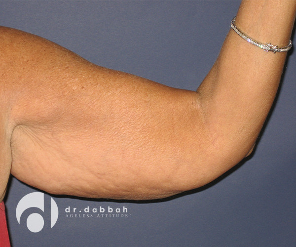 before armlift left arm front view female patient case 2548