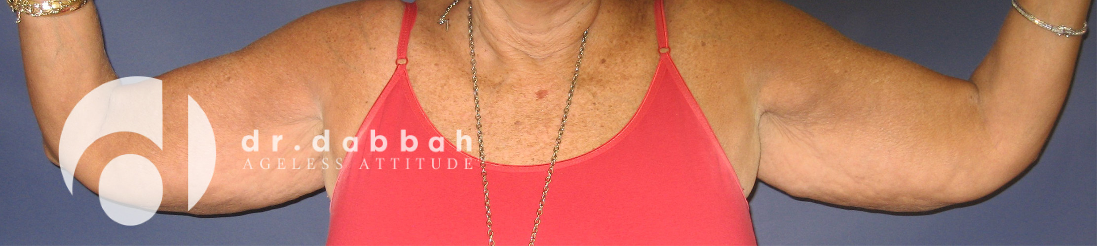 before armlift front view female patient case 2548