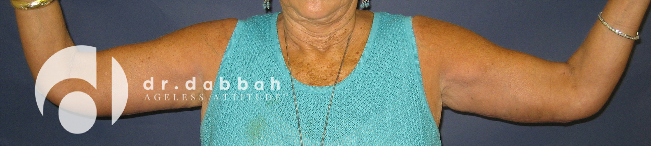 after armlift front view female patient case 2548