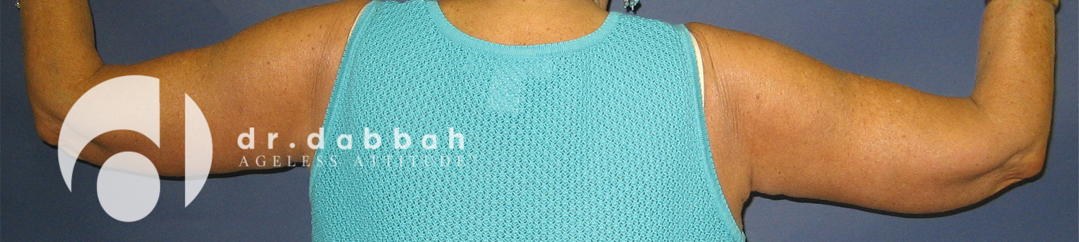 after armlift back view female patient case 2548