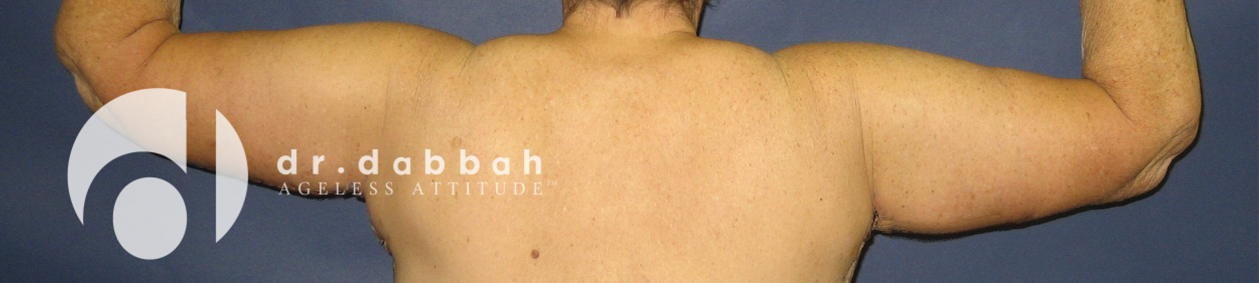 after armlift back view female patient case 2559