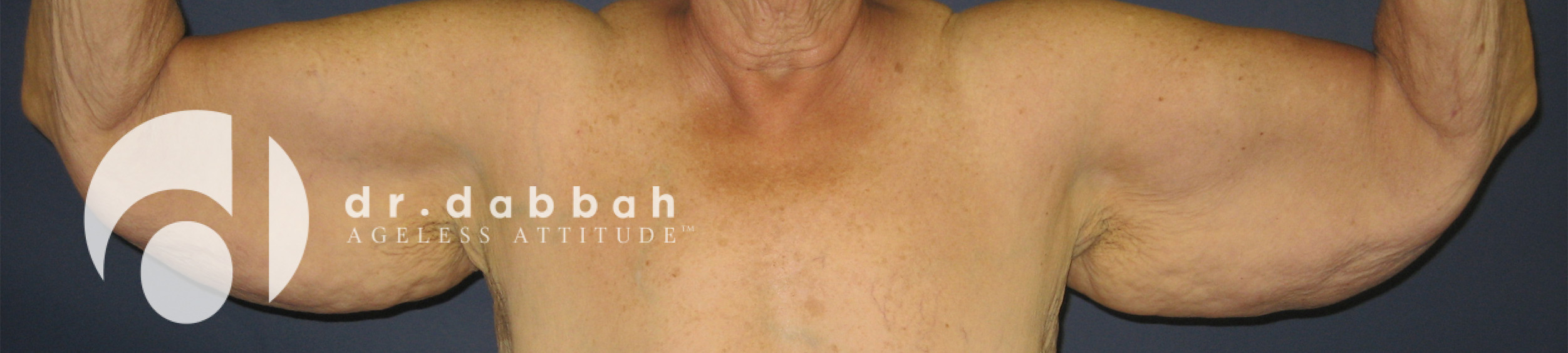 before armlift front view female patient case 2559