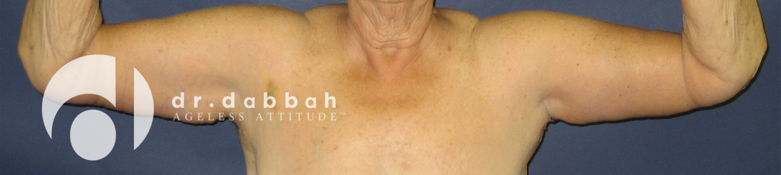 after armlift front view female patient case 2559