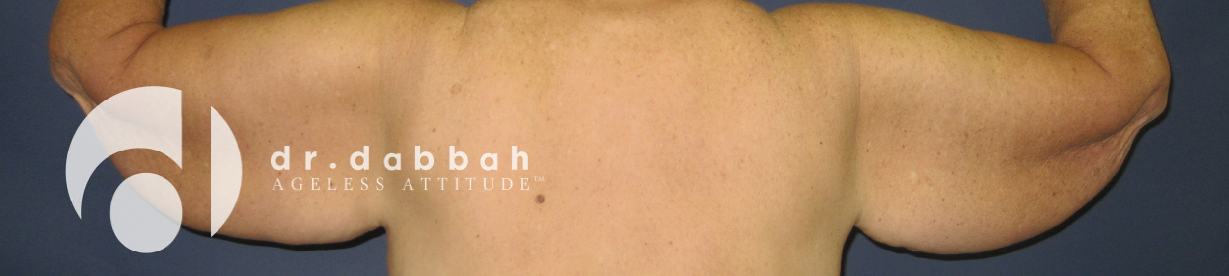 before armlift back view female patient case 2559