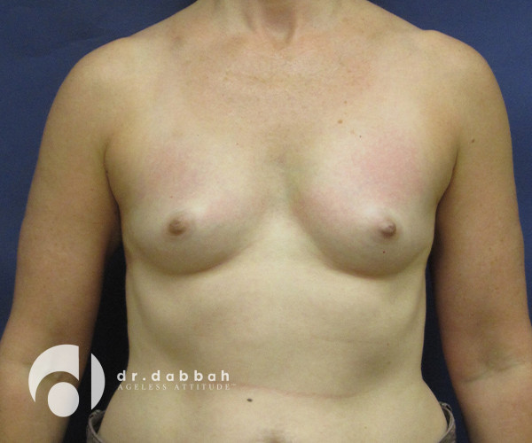 before breast augmentation front view case 2653 | Dr. Albert Dabbah Boca Raton, FL