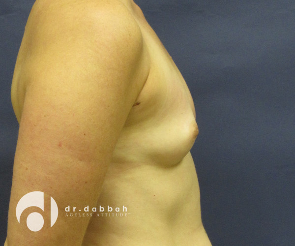 before breast augmentation right side view case 2653 | Dr. Albert Dabbah Boca Raton, FL