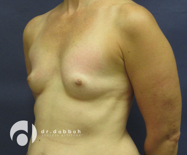 before breast augmentation front left angle view case 2653 | Dr. Albert Dabbah Boca Raton, FL