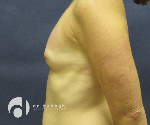 before breast augmentation left side view case 2653 | Dr. Albert Dabbah Boca Raton, FL