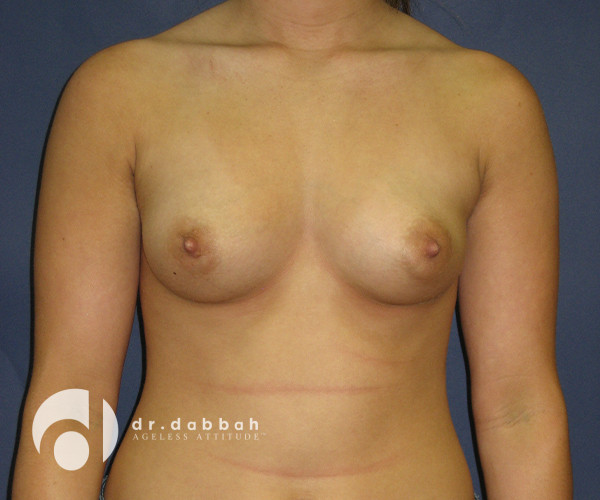 before breast augmentation front view case 2680 | Dr. Albert Dabbah Boca Raton, FL