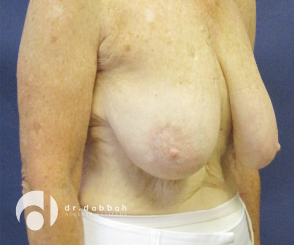 before breast lift with implants right angle view case 2536