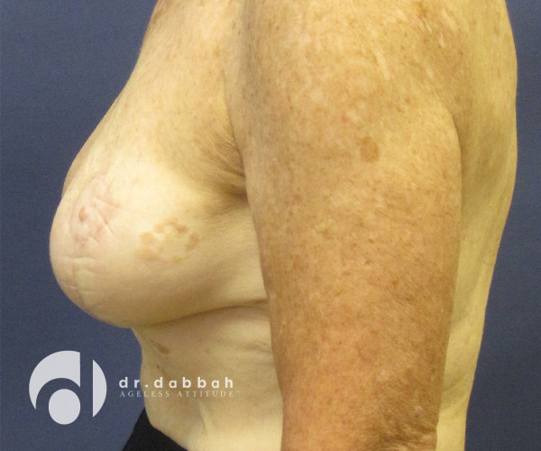 after breast lift with implants left view case 2536