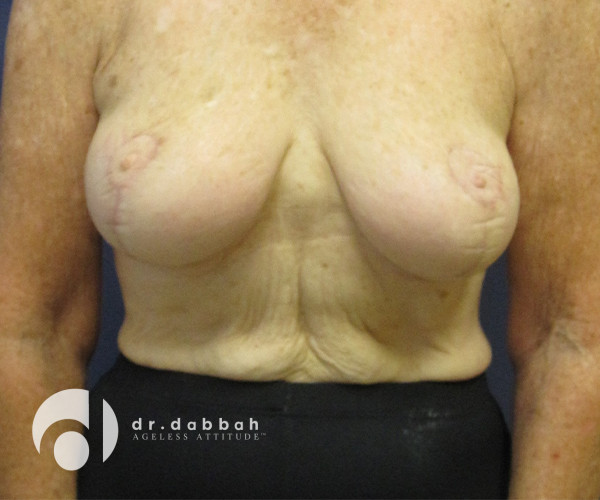 after breast lift with implants front view case 2536