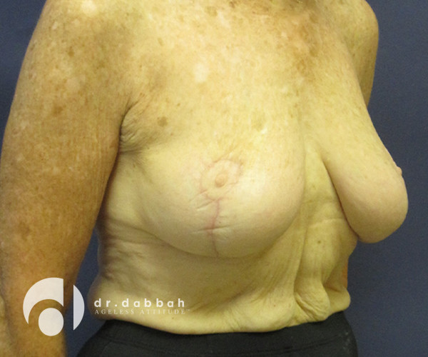 after breast lift with implants right angle view case 2536
