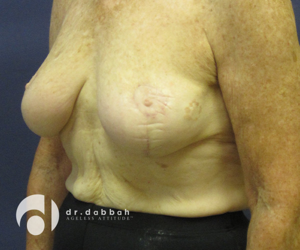before breast lift with implants left angle view case 2536