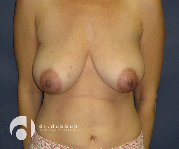 before breast reduction front view case 2738