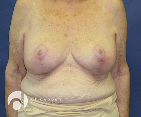 after breast revision front view case 2302 Boca Raton, FL