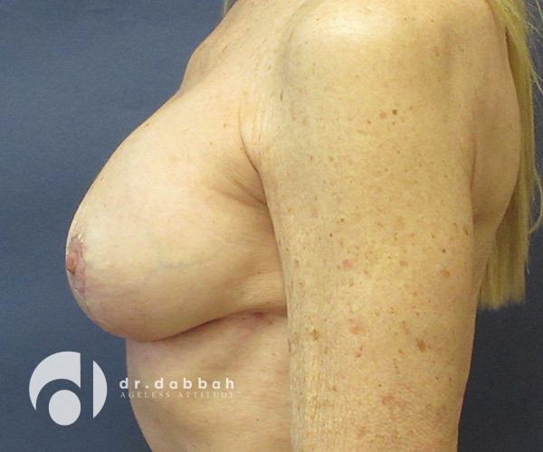after breast revision surgery left side view case 2319