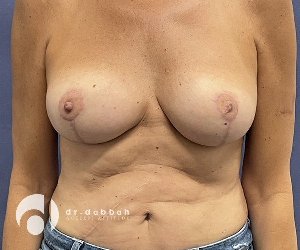 after breast revision surgery front view case 2330