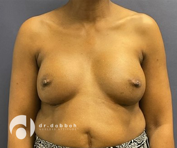after breast revision surgery front view case 2344