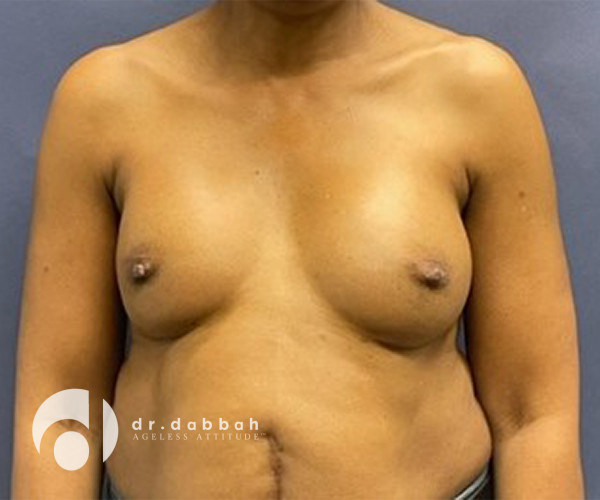 before breast revision surgery front view case 2344